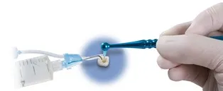 endo-Vac irrigation system can be used in your treatment
