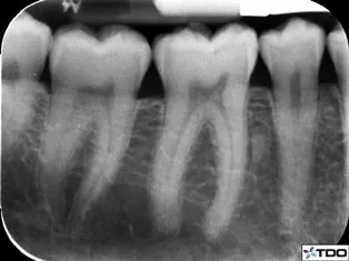 Advanced dental imaging system-computed dental radiography can be used in planning treatment